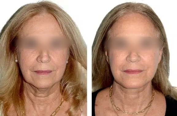 Lifting Facial y Cuello caso 8 — antes y después